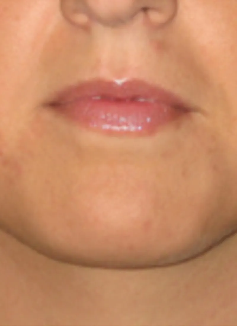 Endodefine Laser Facelift after treatment by Dr Q