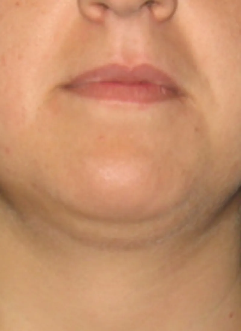 Before Refinement with Endodefine laser