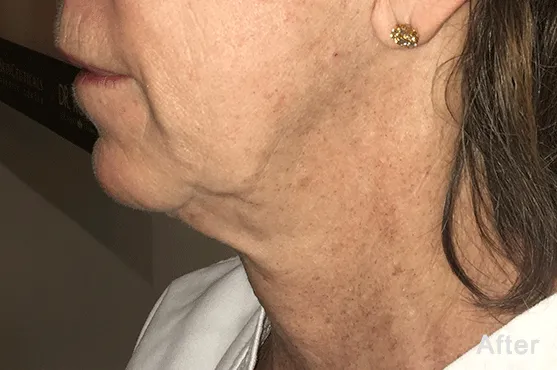 Morpheus8 after treatment by Dr Q