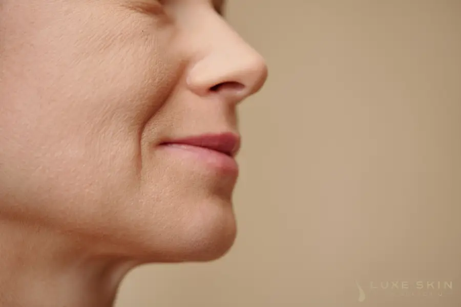 Nasolabial Folds Solutions