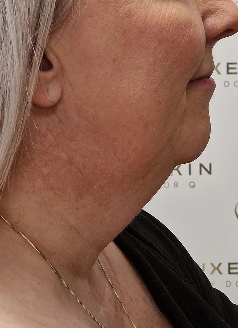 Necklift before treatment at Luxe Skin Glasgow