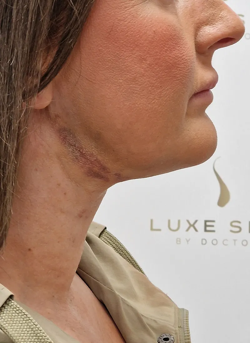 Necklift after treatment by Dr Q