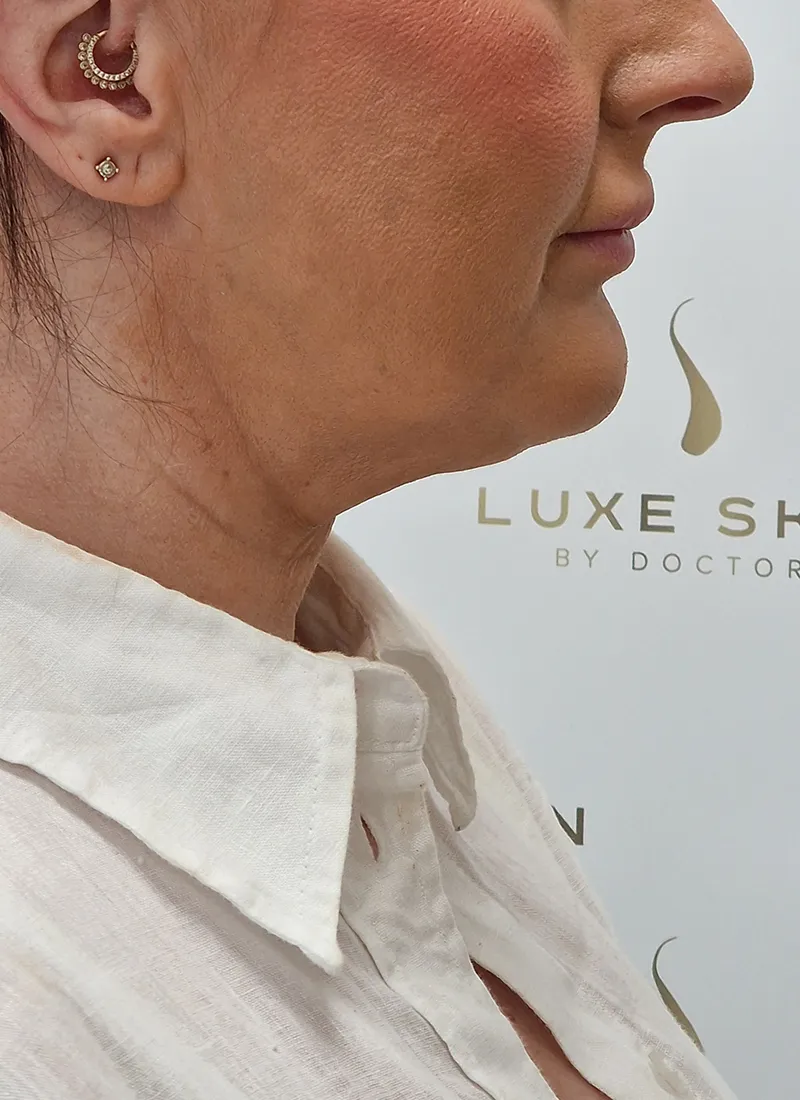 Necklift by Dr Q in Glasgow Before Treatment