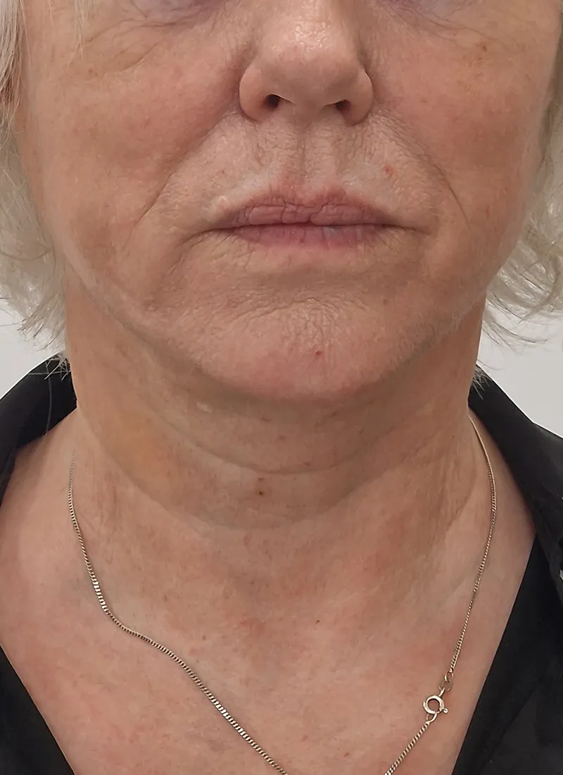 Q lift Non surgical facelift treatment at Luxe Skin Glasgow after the treatment