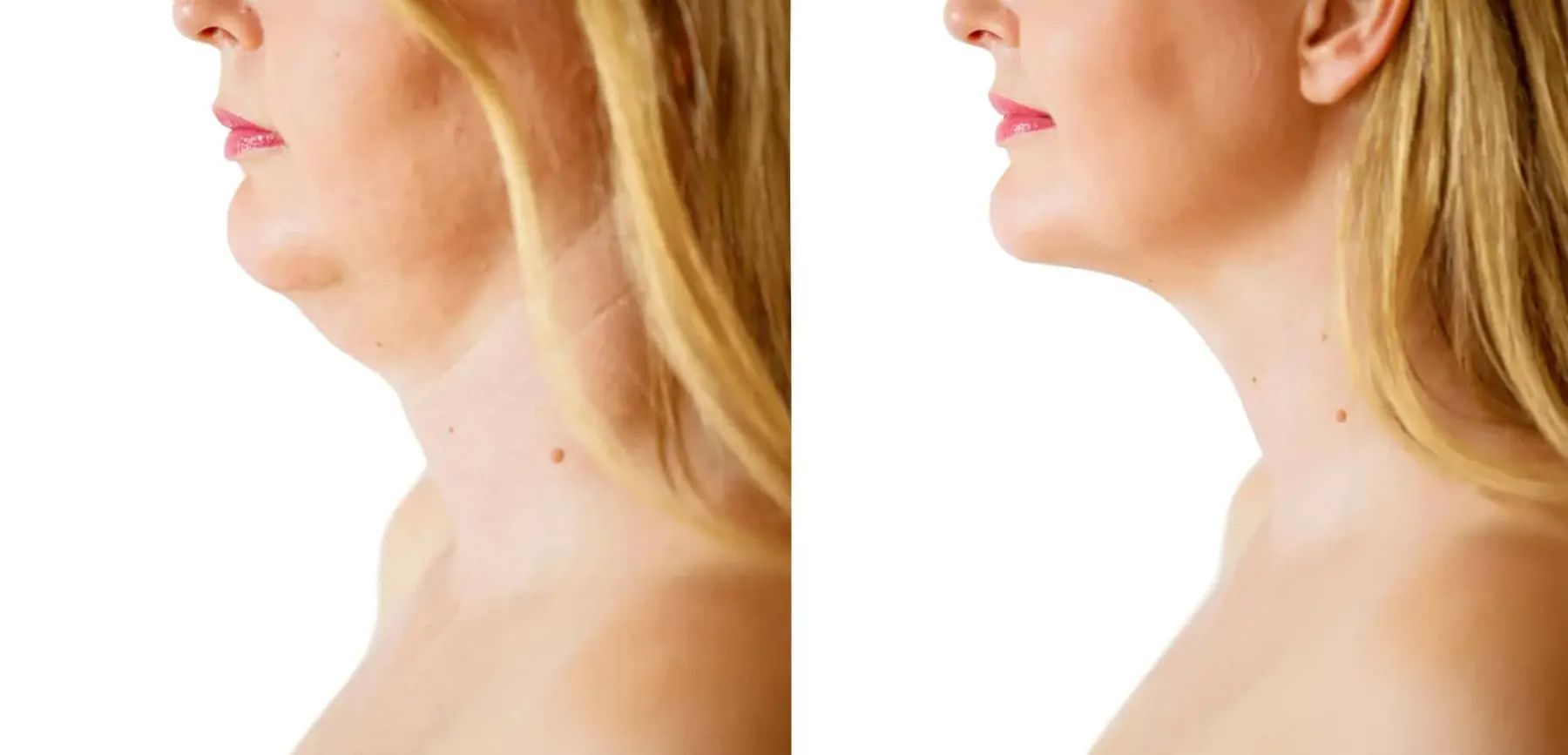 What Is a Nonsurgical Neck Lift and What Are the Benefits?