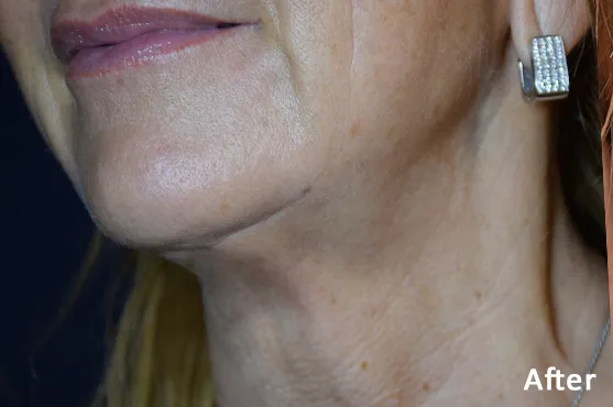Morpheus8 after treatment by Dr Q