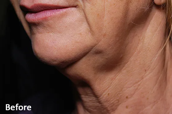Morpheus8 Before Treatment with Dr Q