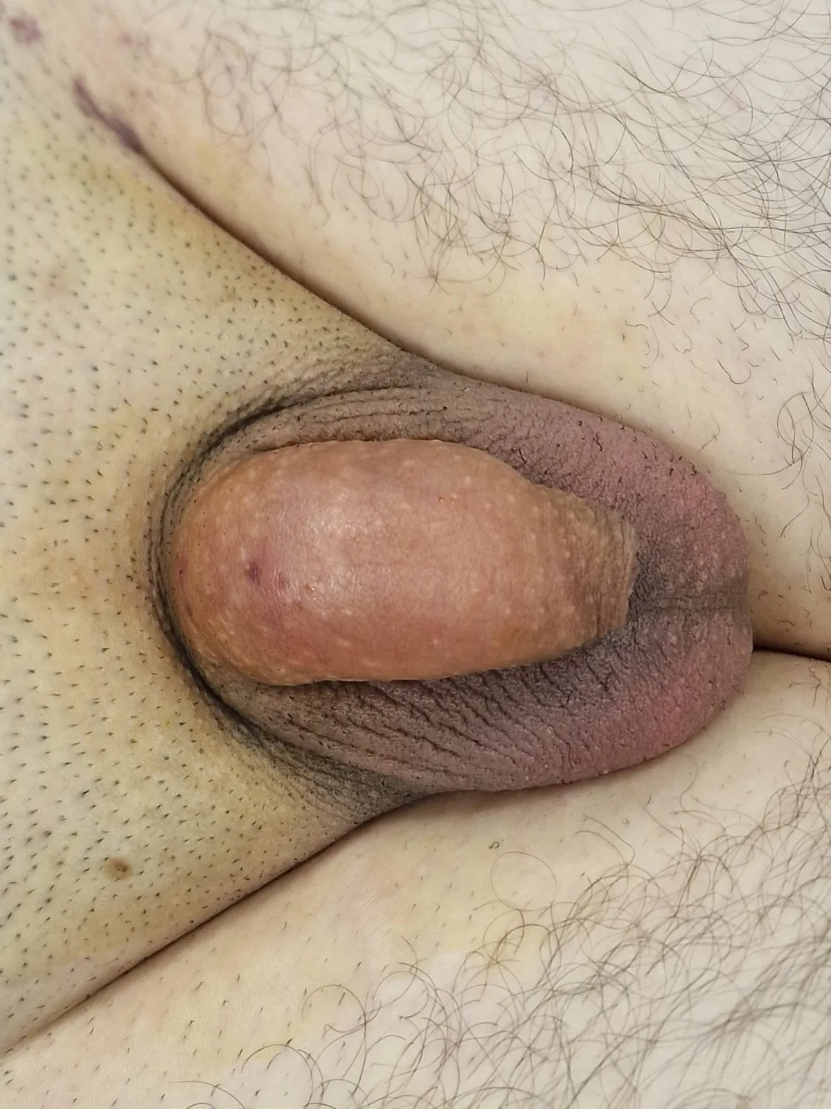 Penis enlargement after treatment by Dr Q