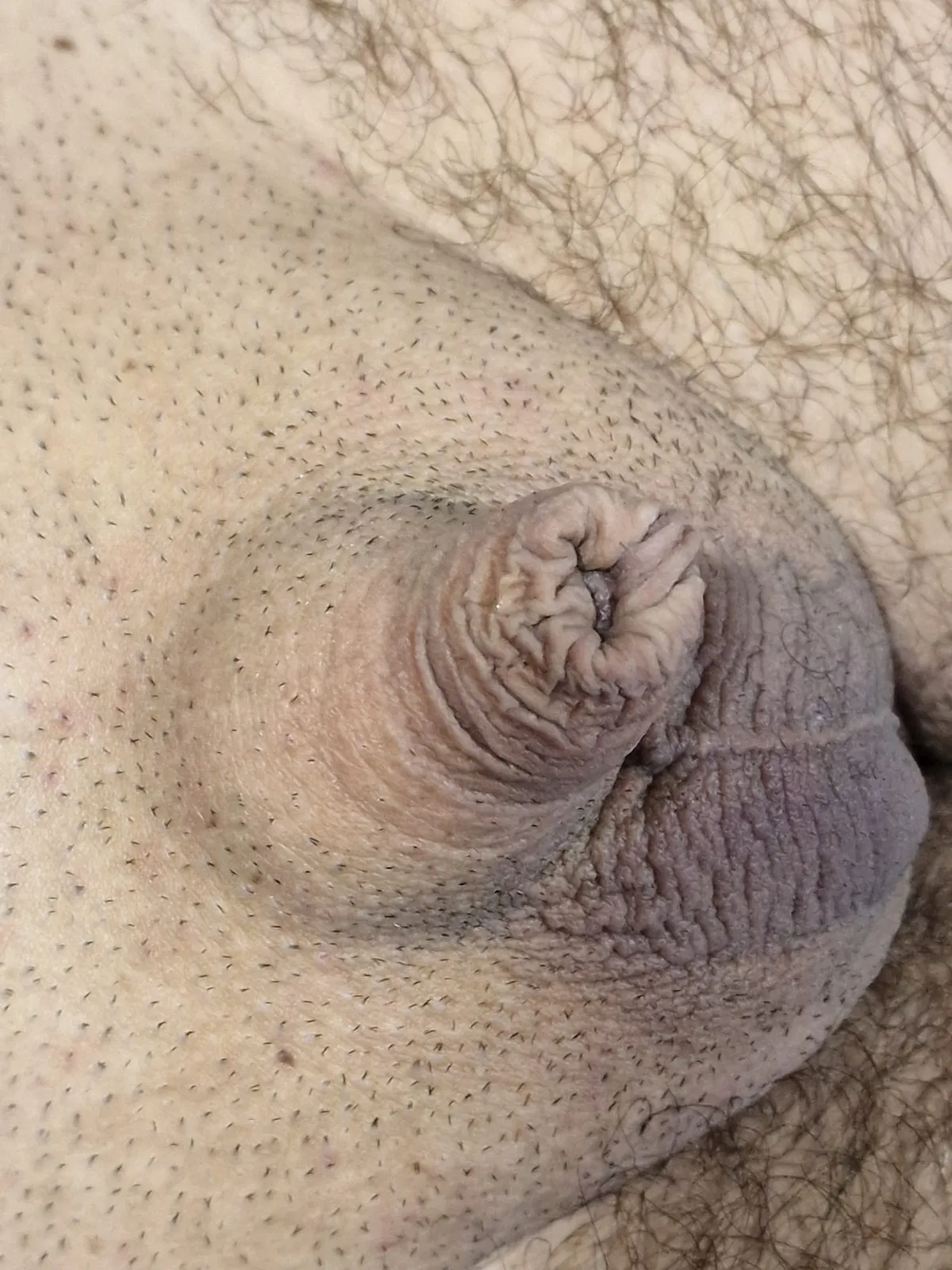 penis enlargement surgery before at Luxe Skin Glasgow