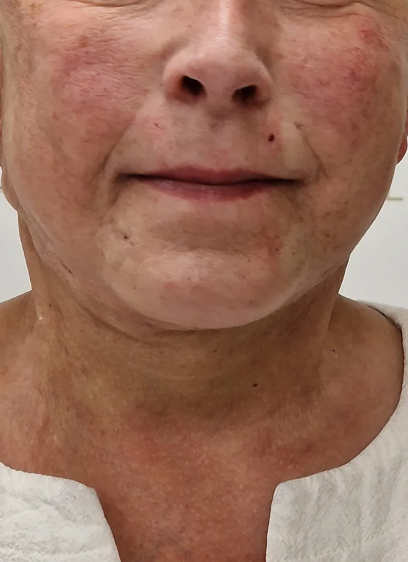 Spring Thread Lift after treatment by Dr Q