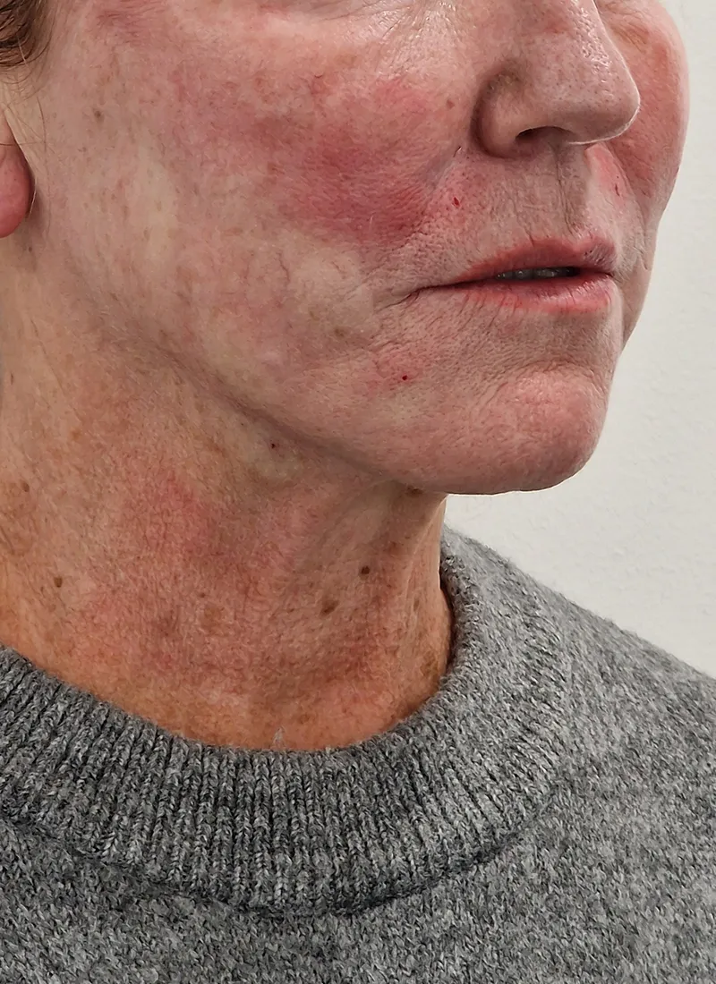 Q Lift After Treatment
