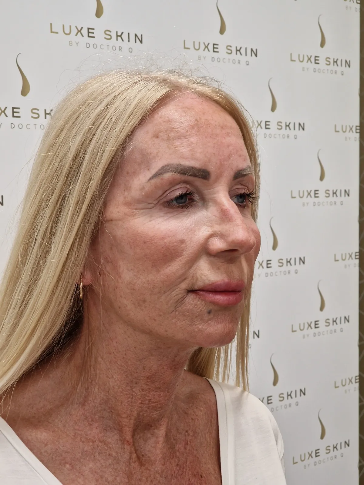 Q Lift After Treatment by Dr Q