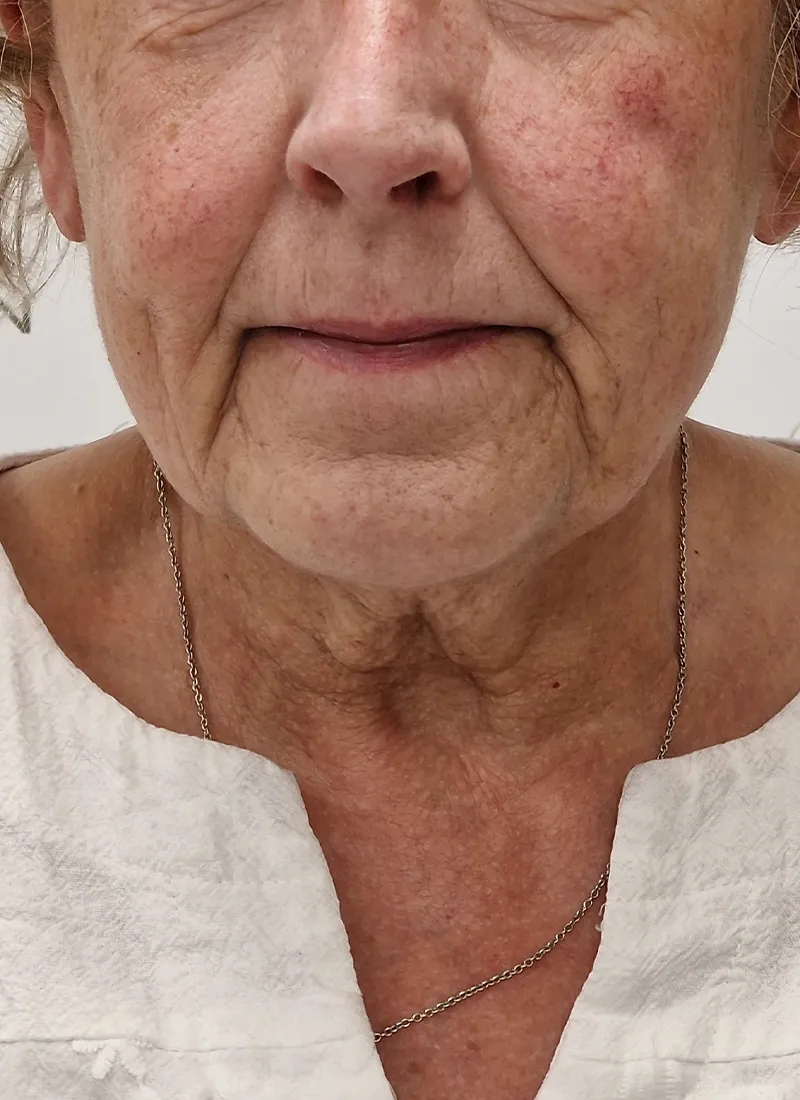 Q lift Before at Luxe Skin Glasgow