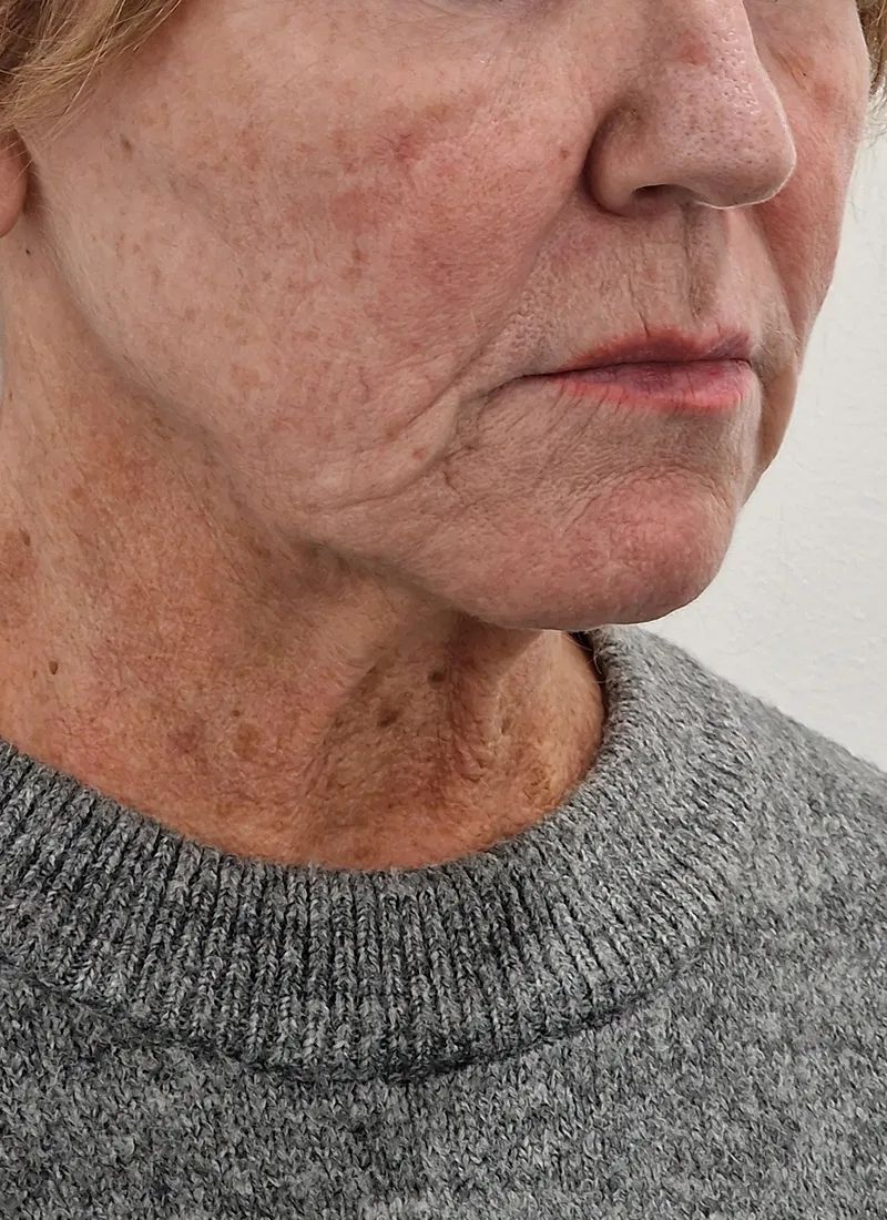 Spring Thread Lift before treatment at Luxe Skin Glasgow