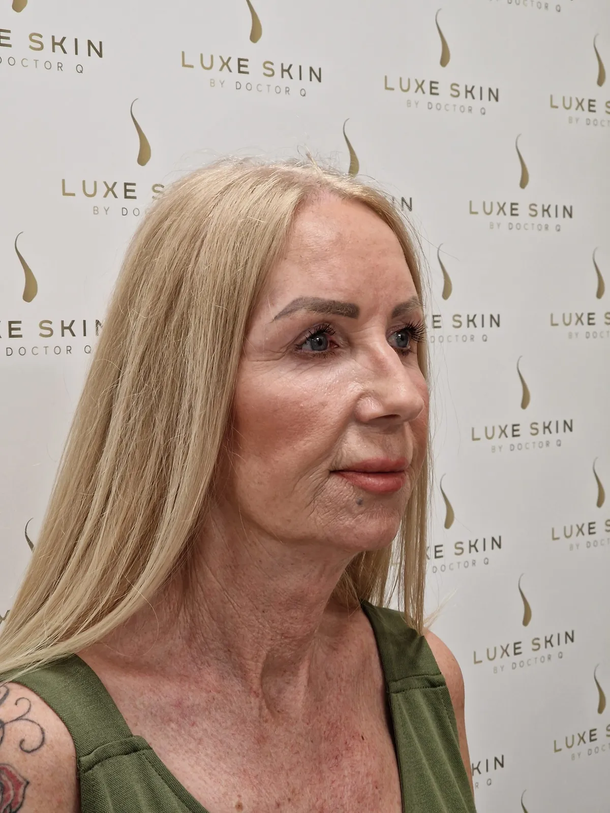 Spring Thread Lift before treatment at Luxe Skin Glasgow