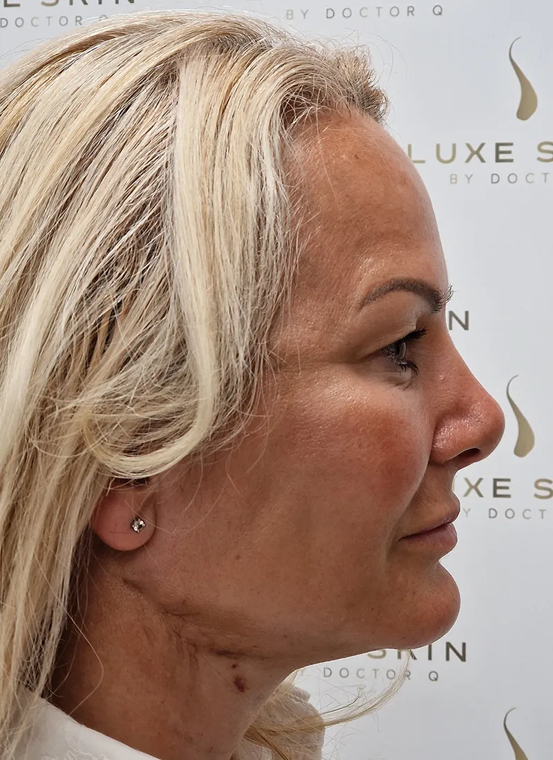 Q Lift Face Lift After