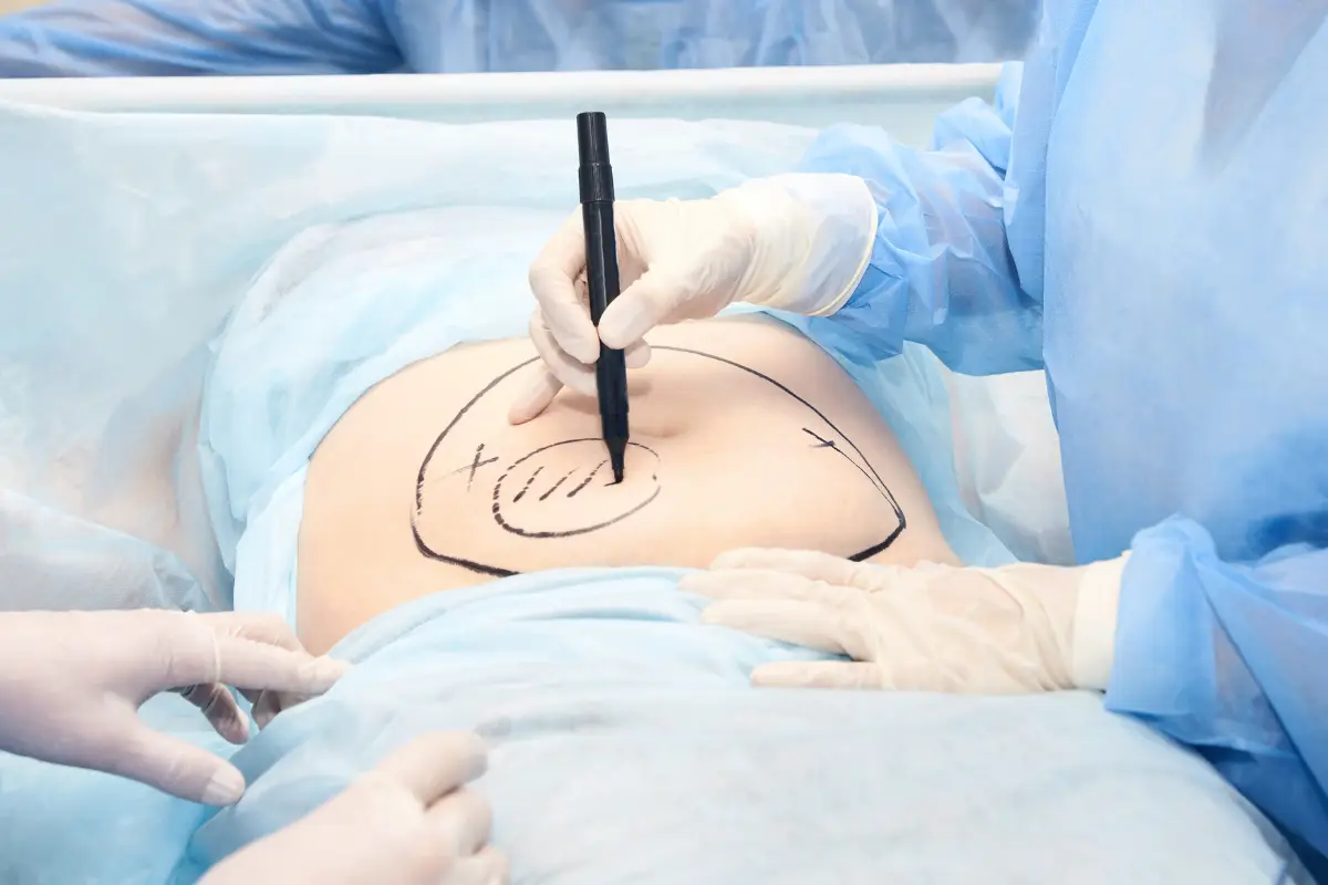Recovery Guide After Liposuction