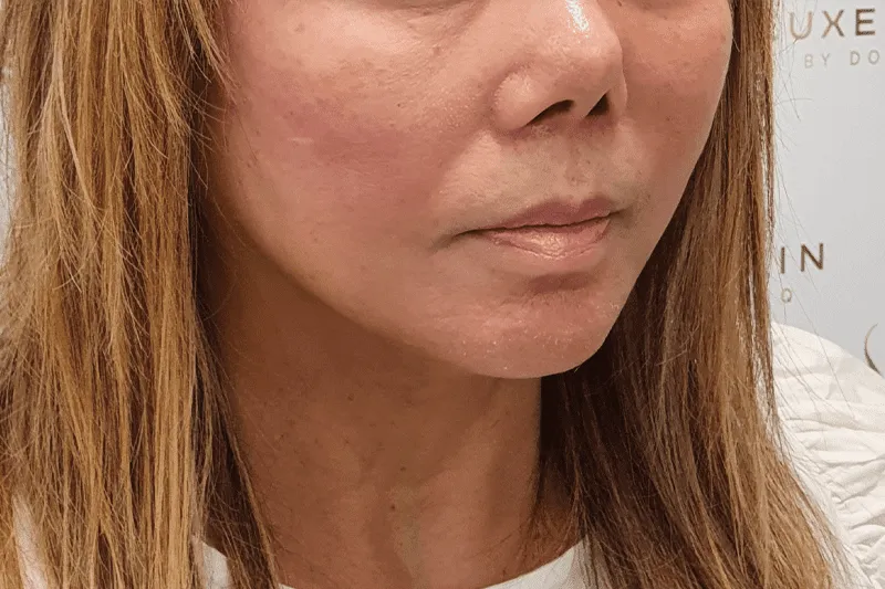 Thread Lift Treatment Client After at Luxe Skin Aesthetic Clinic in Glasgow by Dr q