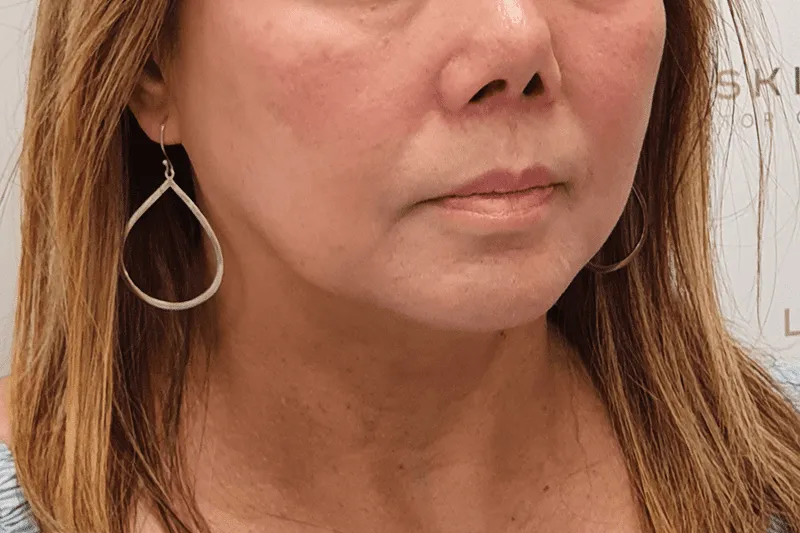 Thread Lift Treatment Client Before at Luxe Skin Aesthetic Clinic in Glasgow by Dr Q