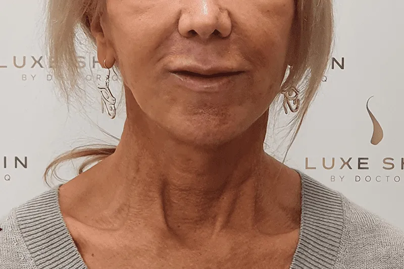 Thread Lift Client After Treatment at Luxe Skin Aesthetic Clinic in Glasgow by Dr q