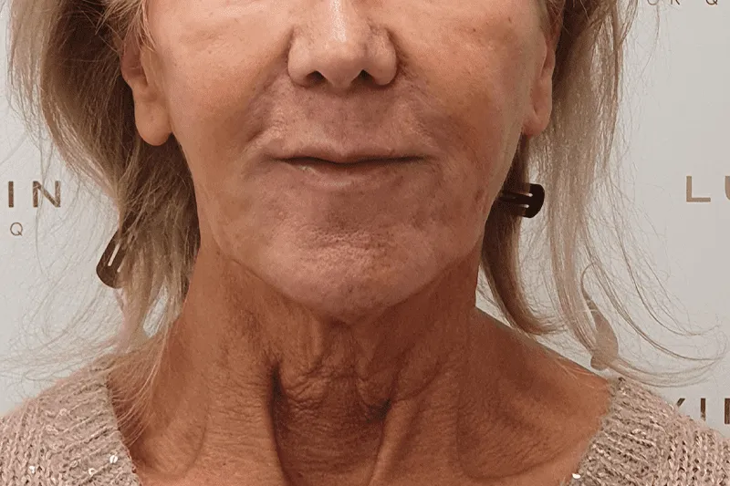 Thread Lift Client Before Treatment at Luxe Skin Aesthetic Clinic in Glasgow by Dr q