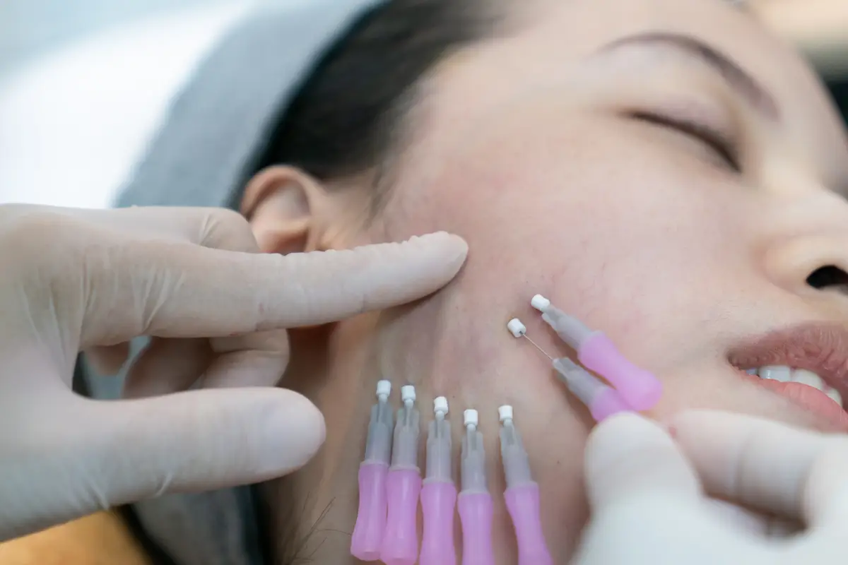 Thread Lifts vs. Liquid Lifts: Choosing the Right Non-Surgical Facelift for Your Age