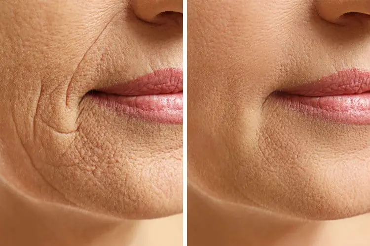 Cosmetic Treatment - Smokers Lines Before & After